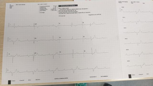 ECG: Bloqueo AV completo