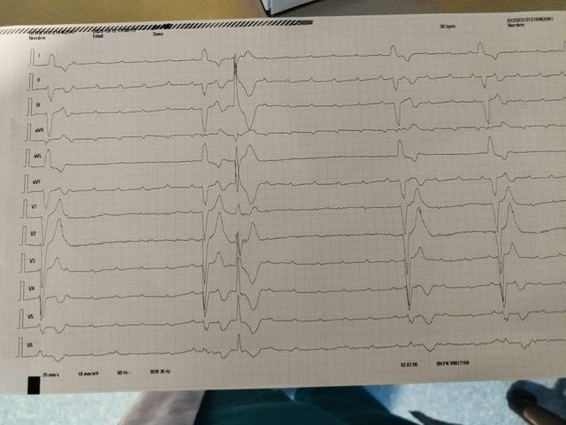 ECG: Bloqueo AV completo