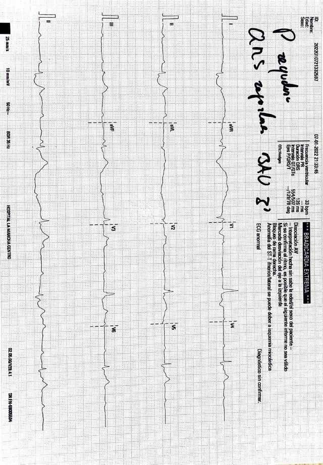 ECG: Bloqueo AV completo