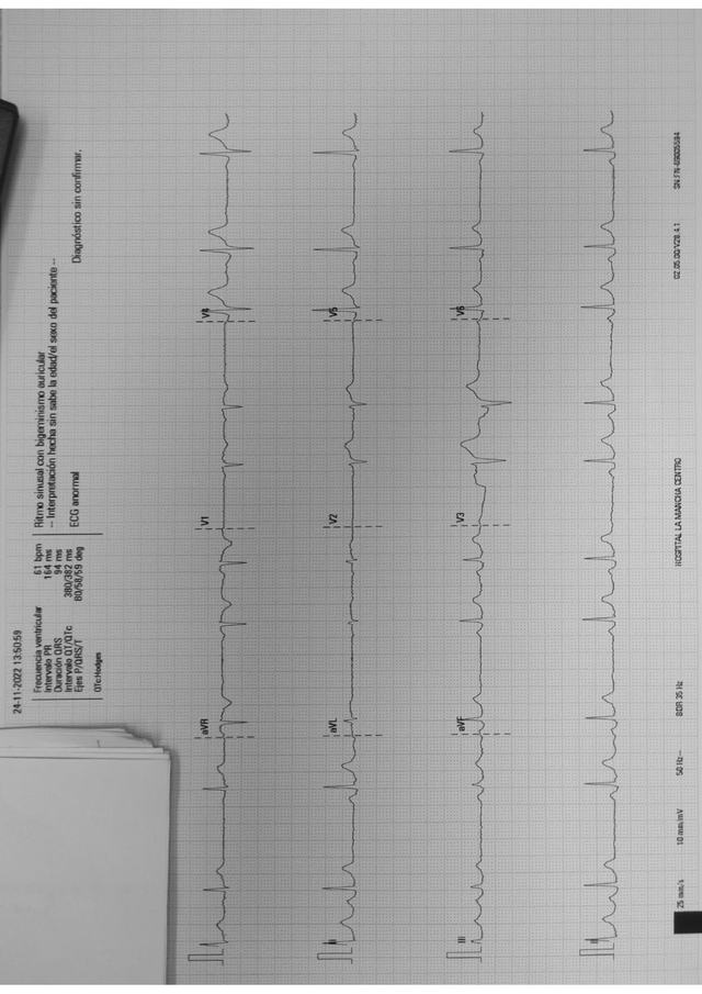 ECG: Bigeminismo auricular