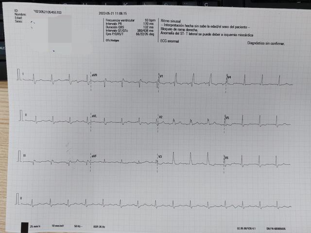 ECG: Bloqueo de rama derecha