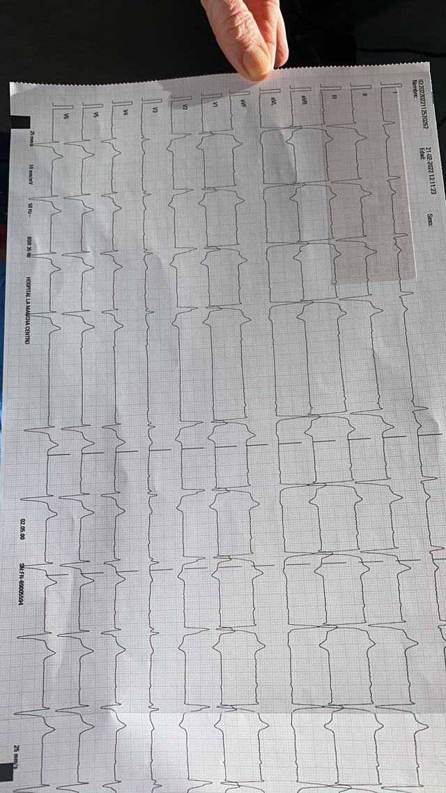 ECG: Bloqueo trifascular (BAV 2º grado Mobitz II)