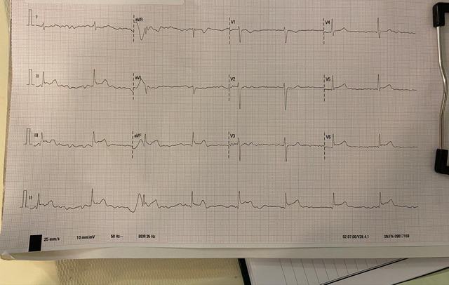 ECG: Elevación del ST (arteria circunfleja)