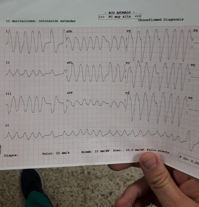ECG: FA con conducción aberrante
