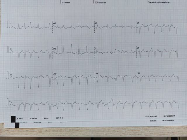 ECG: Fibrilación auricular rápida