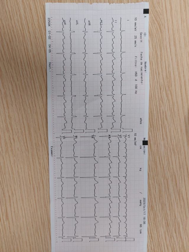 ECG: Flutter auricular