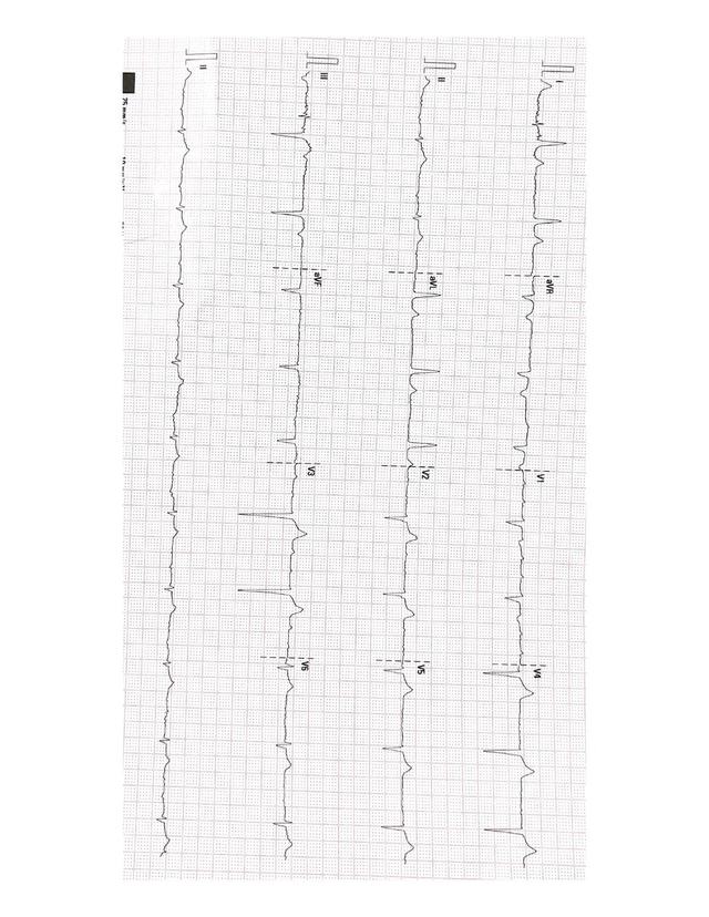 ECG: Flutter auricular
