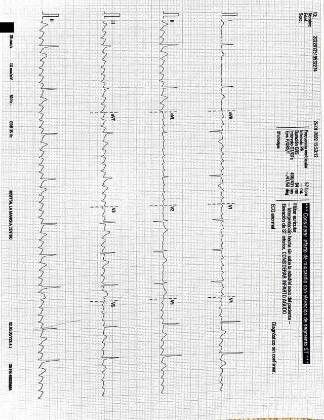 ECG: Flutter auricular