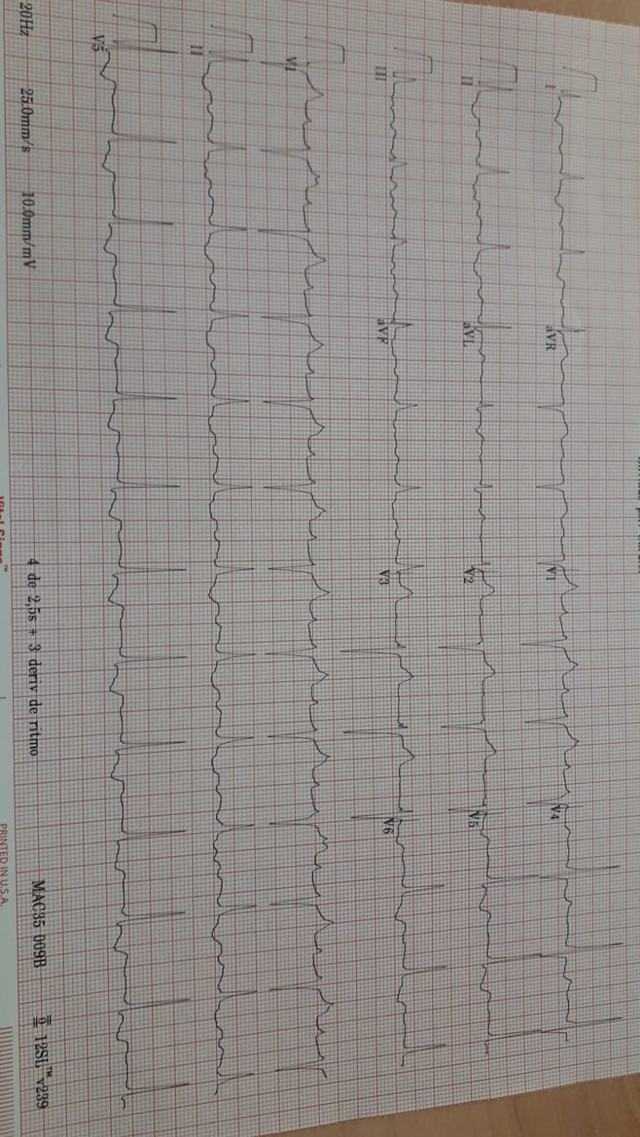 ECG: Flutter atípico
