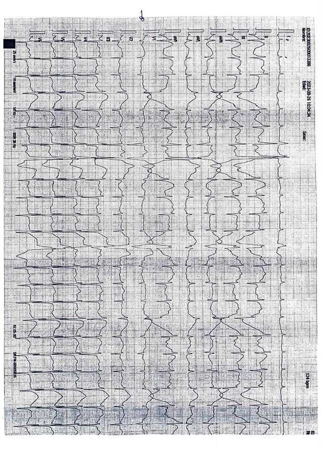 ECG: Flutter no común