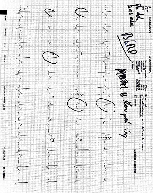 ECG: Hemibloqueo posterior izquierdo