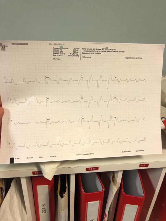 ECG: Hiperpotasemia