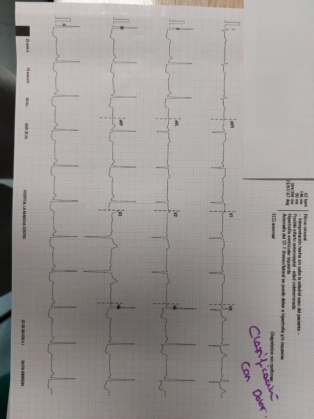 ECG: Infarto inferior