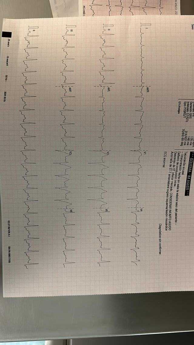 ECG: Infradesnivel del ST con elevación de aVR