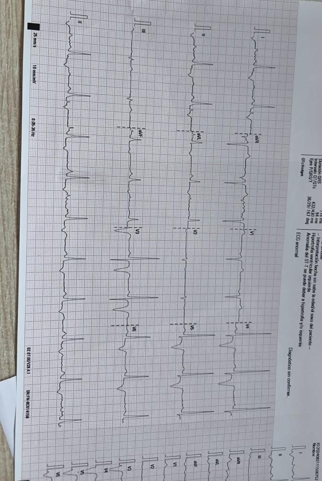 ECG: Miocardiopatía hipertrófica
