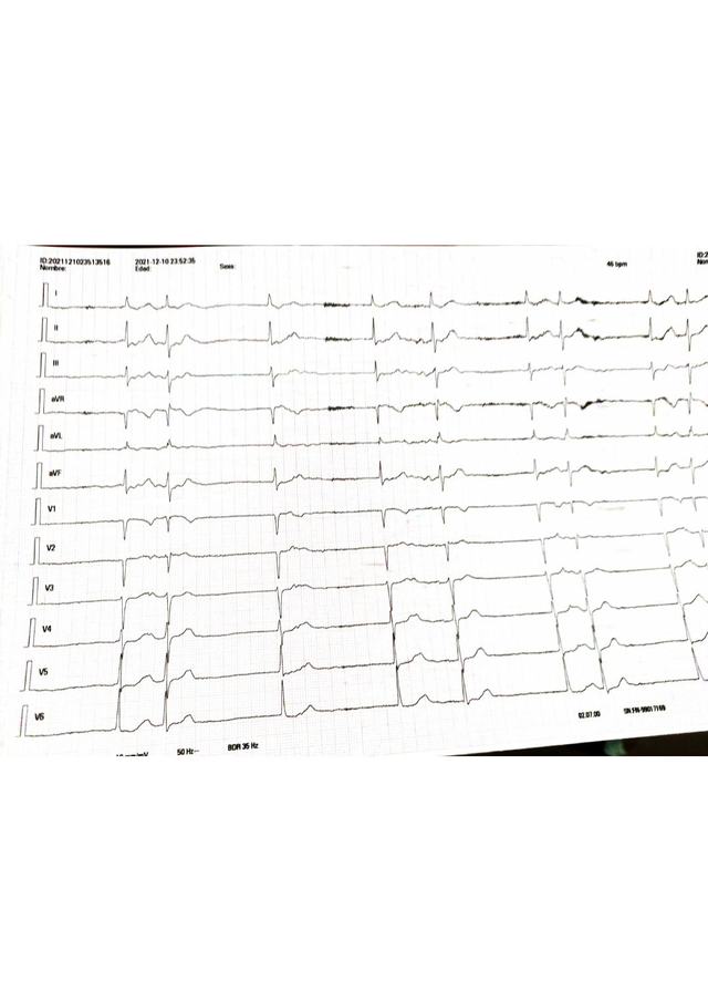 ECG: Paro sinusal con escape nodal