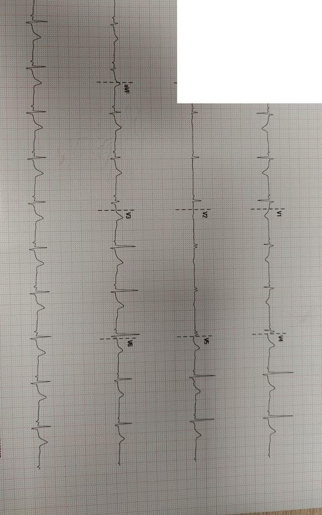 ECG: Ritmo auricular ectópico