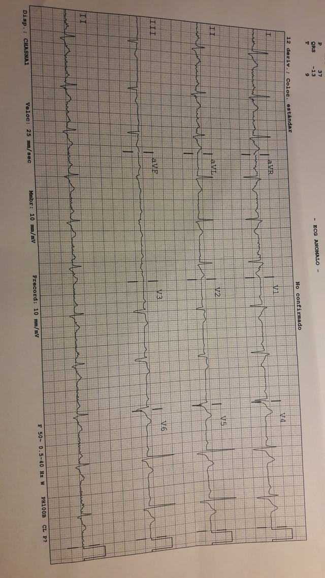 ECG: Síndrome de Brugada