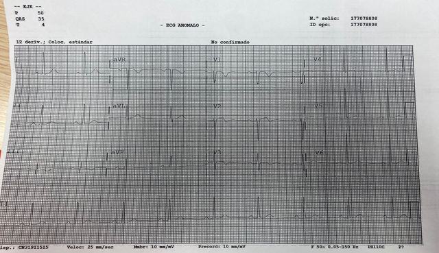 ECG: Sobrecarga derecha (posible DAVD)