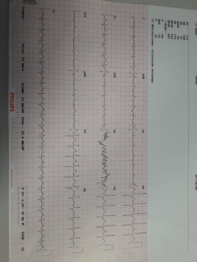 ECG: Taquicardia auricular de foco ectópico
