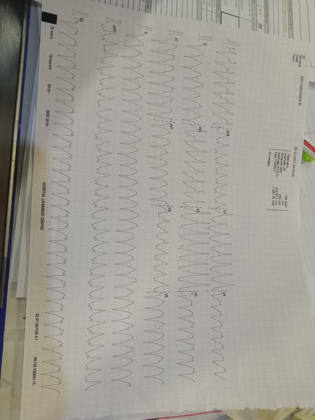 ECG: Taquicardia ventricular