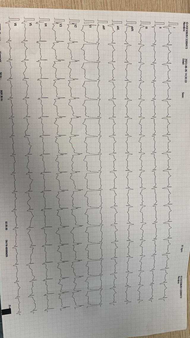 ECG: Tromboembolismo pulmonar (TEP)