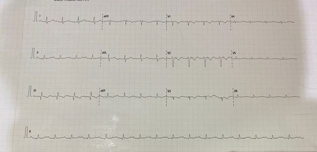 ECG: Tromboembolismo pulmonar (TEP)