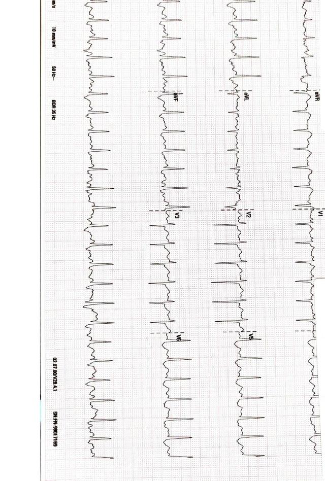 ECG: TSV en WPW (Wolff-Parkinson-White)